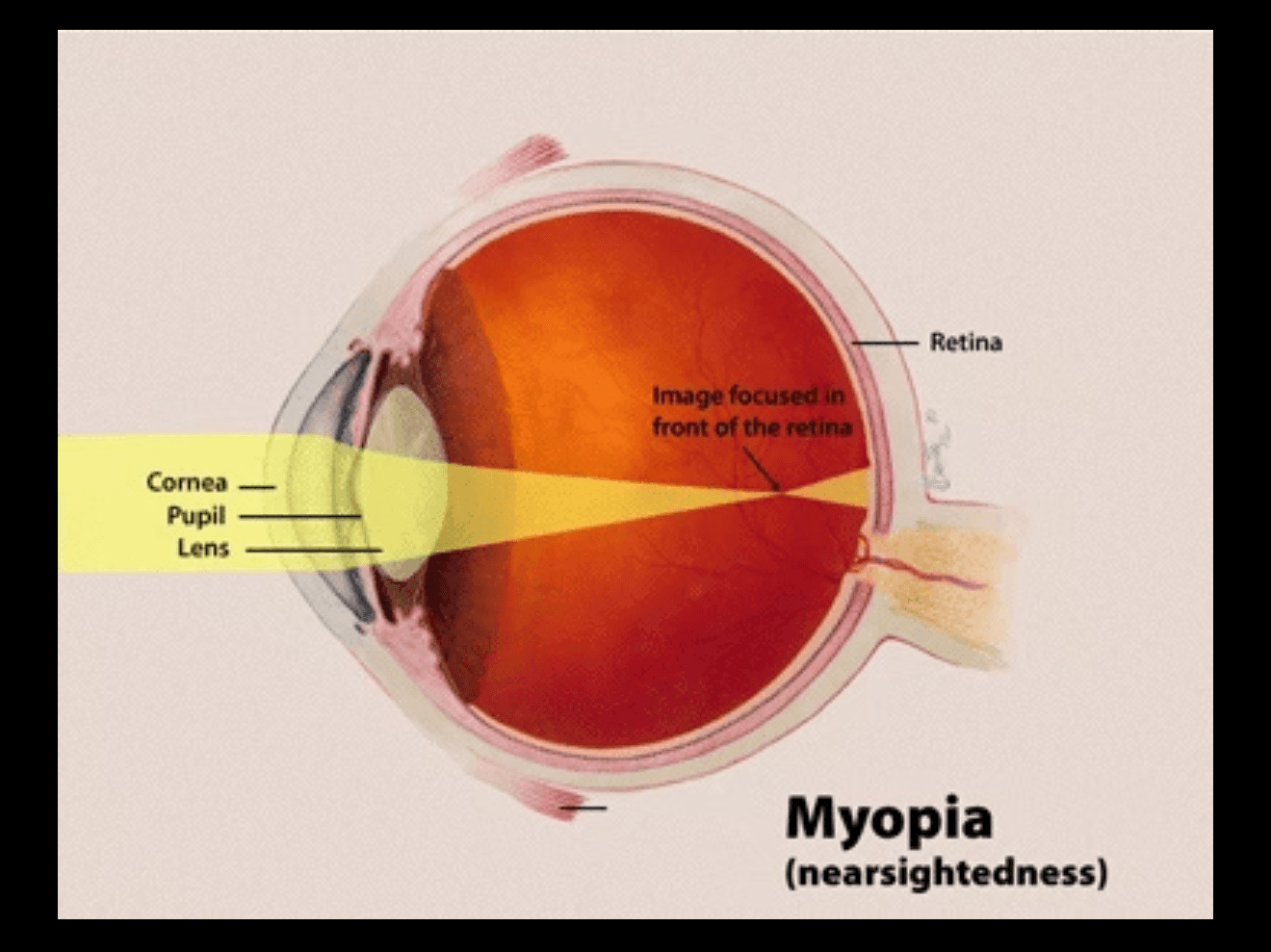 Myopia (nearsightedness) diagram