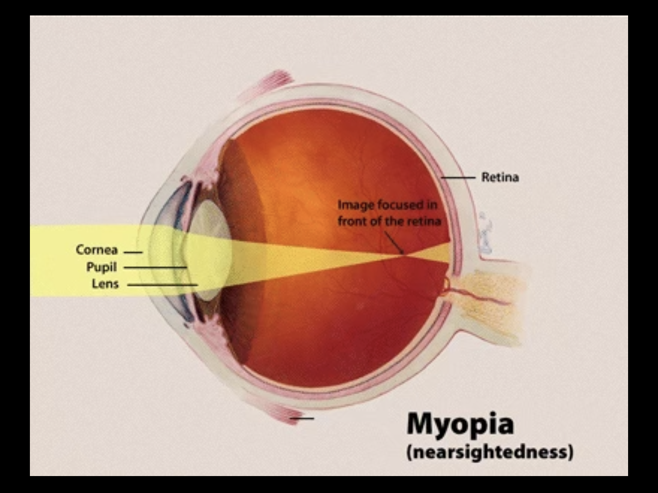 Myopia (nearsightedness) diagram